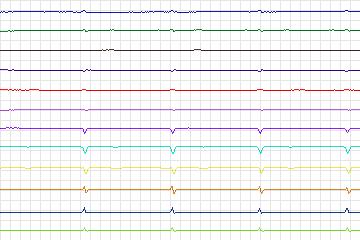 Electrocardiogram for PTB Diagnostic ECG, record s0051lre-patient013