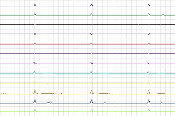 Electrocardiogram for PTB Diagnostic ECG, record s0052lre-patient016