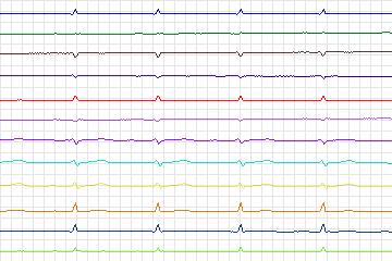 Electrocardiogram for PTB Diagnostic ECG, record s0053lre-patient017