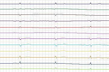 Electrocardiogram for PTB Diagnostic ECG, record s0055lre-patient017