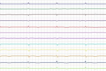Electrocardiogram for PTB Diagnostic ECG, record s0056lre-patient014