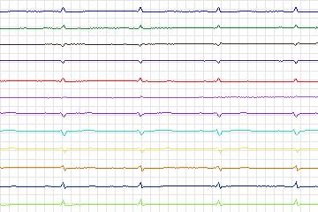 Electrocardiogram for PTB Diagnostic ECG, record s0057lre-patient015