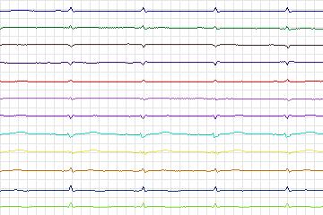 Electrocardiogram for PTB Diagnostic ECG, record s0058lre-patient019
