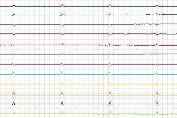 Electrocardiogram for PTB Diagnostic ECG, record s0060lre-patient016