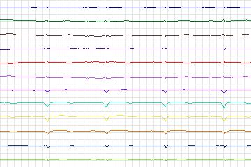 Electrocardiogram for PTB Diagnostic ECG, record s0061lre-patient010