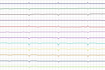 Electrocardiogram for PTB Diagnostic ECG, record s0062lre-patient020