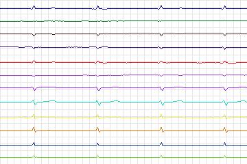 Electrocardiogram for PTB Diagnostic ECG, record s0063lre-patient017