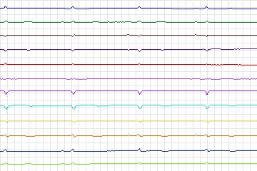 Electrocardiogram for PTB Diagnostic ECG, record s0064lre-patient006