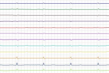 Electrocardiogram for PTB Diagnostic ECG, record s0065lre-patient021