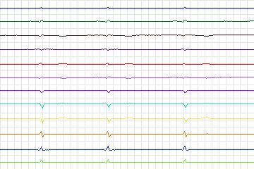 Electrocardiogram for PTB Diagnostic ECG, record s0067lre-patient011