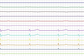 Electrocardiogram for PTB Diagnostic ECG, record s0068lre-patient008