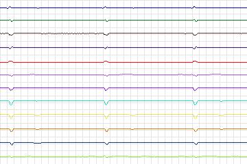 Electrocardiogram for PTB Diagnostic ECG, record s0069lre-patient020