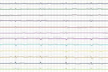 Electrocardiogram for PTB Diagnostic ECG, record s0072lre-patient013