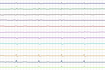 Electrocardiogram for PTB Diagnostic ECG, record s0073lre-patient021