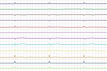 Electrocardiogram for PTB Diagnostic ECG, record s0075lre-patient017