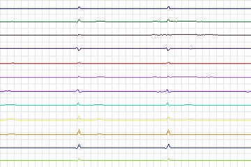 Electrocardiogram for PTB Diagnostic ECG, record s0076lre-patient016