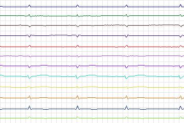 Electrocardiogram for PTB Diagnostic ECG, record s0077lre-patient019