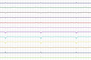 Electrocardiogram for PTB Diagnostic ECG, record s0078lre-patient007