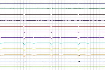 Electrocardiogram for PTB Diagnostic ECG, record s0079lre-patient020