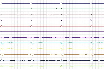 Electrocardiogram for PTB Diagnostic ECG, record s0082lre-patient018