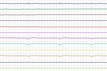 Electrocardiogram for PTB Diagnostic ECG, record s0086lre-patient024