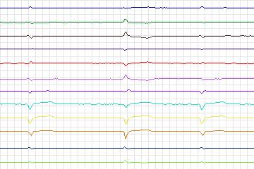 Electrocardiogram for PTB Diagnostic ECG, record s0087lre-patient025