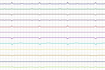 Electrocardiogram for PTB Diagnostic ECG, record s0088lre-patient026