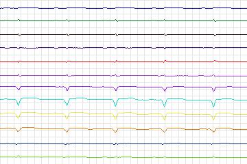 Electrocardiogram for PTB Diagnostic ECG, record s0089lre-patient027