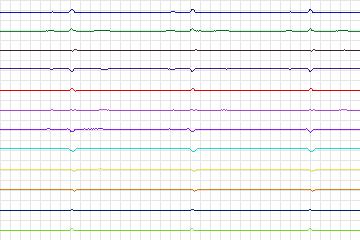 Electrocardiogram for PTB Diagnostic ECG, record s0090lre-patient028