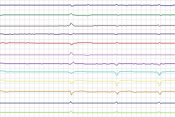 Electrocardiogram for PTB Diagnostic ECG, record s0091lre-patient025