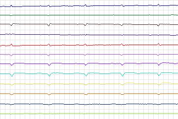 Electrocardiogram for PTB Diagnostic ECG, record s0092lre-patient029