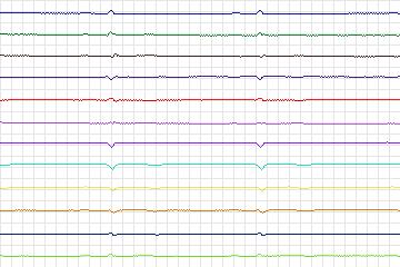 Electrocardiogram for PTB Diagnostic ECG, record s0093lre-patient028