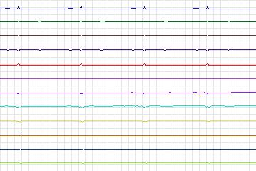 Electrocardiogram for PTB Diagnostic ECG, record s0094lre-patient024