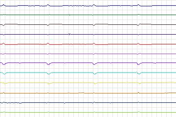 Electrocardiogram for PTB Diagnostic ECG, record s0095lre-patient026
