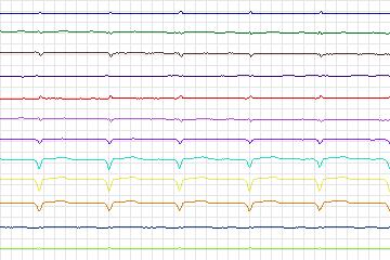 Electrocardiogram for PTB Diagnostic ECG, record s0096lre-patient027