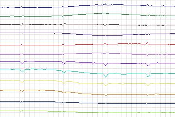 Electrocardiogram for PTB Diagnostic ECG, record s0098lre-patient029