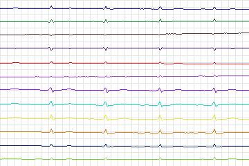Electrocardiogram for PTB Diagnostic ECG, record s0100lre-patient031