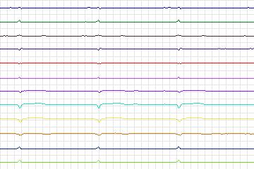Electrocardiogram for PTB Diagnostic ECG, record s0101lre-patient005