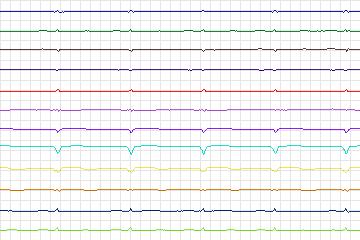 Electrocardiogram for PTB Diagnostic ECG, record s0102lre-patient032