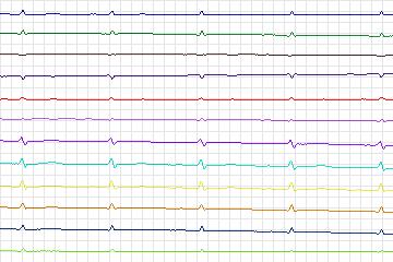 Electrocardiogram for PTB Diagnostic ECG, record s0104lre-patient031