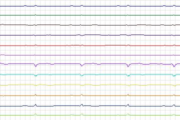 Electrocardiogram for PTB Diagnostic ECG, record s0105lre-patient033