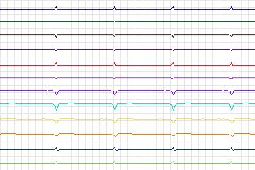 Electrocardiogram for PTB Diagnostic ECG, record s0106lre-patient032