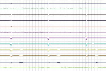 Electrocardiogram for PTB Diagnostic ECG, record s0107lre-patient030