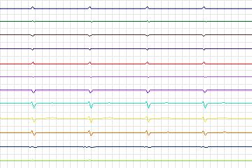 Electrocardiogram for PTB Diagnostic ECG, record s0110lre-patient035