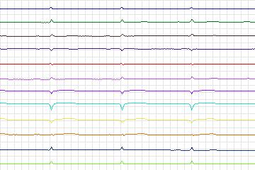 Electrocardiogram for PTB Diagnostic ECG, record s0111lre-patient036