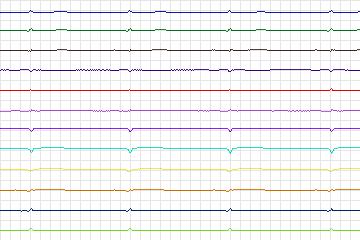 Electrocardiogram for PTB Diagnostic ECG, record s0112lre-patient037