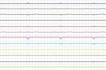 Electrocardiogram for PTB Diagnostic ECG, record s0113lre-patient033