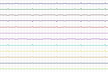 Electrocardiogram for PTB Diagnostic ECG, record s0114lre-patient031