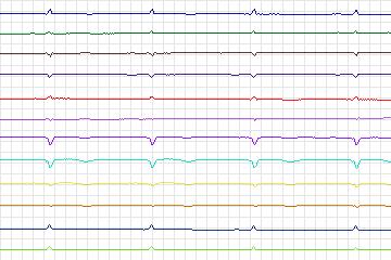 Electrocardiogram for PTB Diagnostic ECG, record s0115lre-patient032