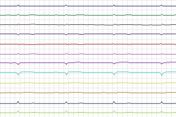 Electrocardiogram for PTB Diagnostic ECG, record s0116lre-patient036